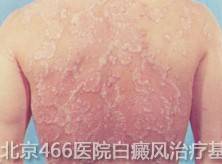 白癜风护理工作该怎么做呢?