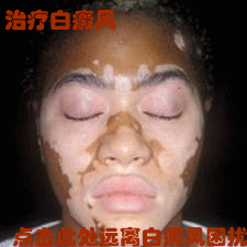 诊断白癜风必须了解白斑症状特点